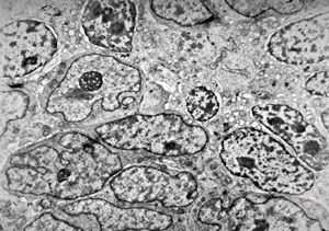M,55y. | small cell carcinoma - lung M,55y. | small cell carcinoma - lung